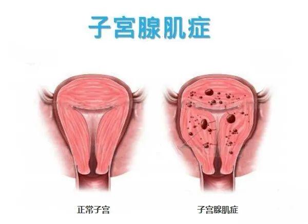 腺肌癥最新治療方法的研究與應用進展